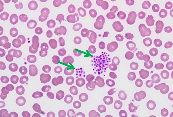 HEMOGRAMA - PSEUDOTROMBOCITOPENIA COMO PROCEDER?